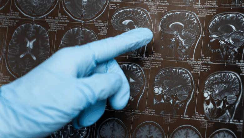 Sintomas do mal de Parkinson